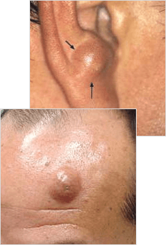 Sebaceous Cyst