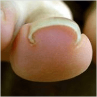 Ingrown Nail